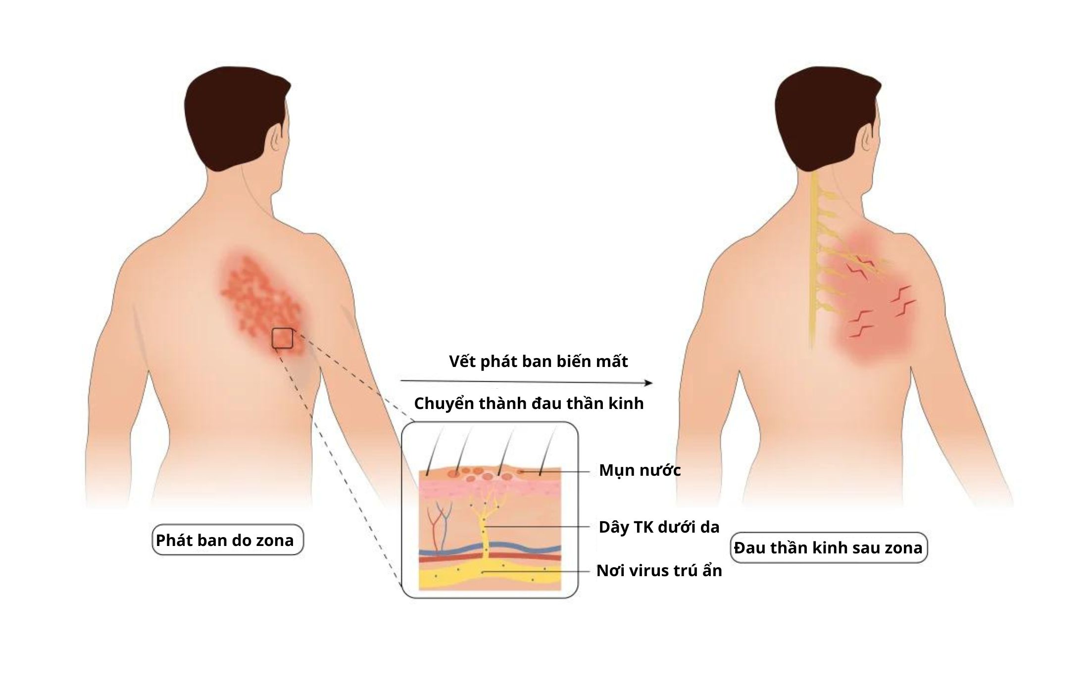 Cách giảm đau sau zona thần kinh đơn giản cho người bị đau thần kinh mãn tính