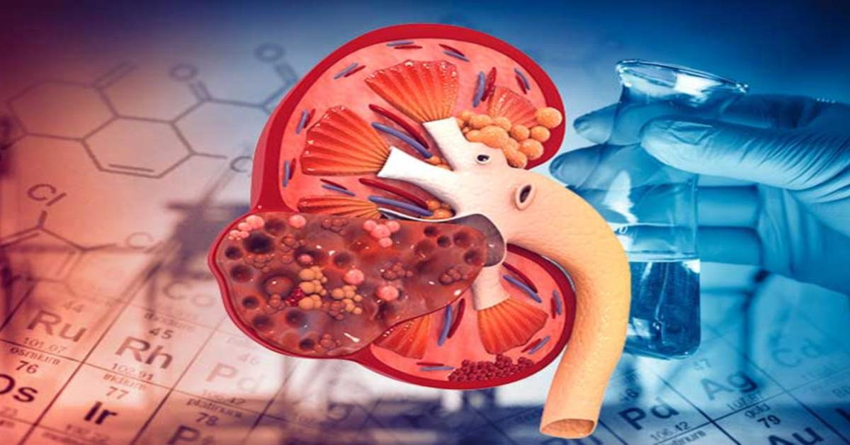 Các giai đoạn suy thận mạn: dấu hiệu nhận biết và cách điều trị