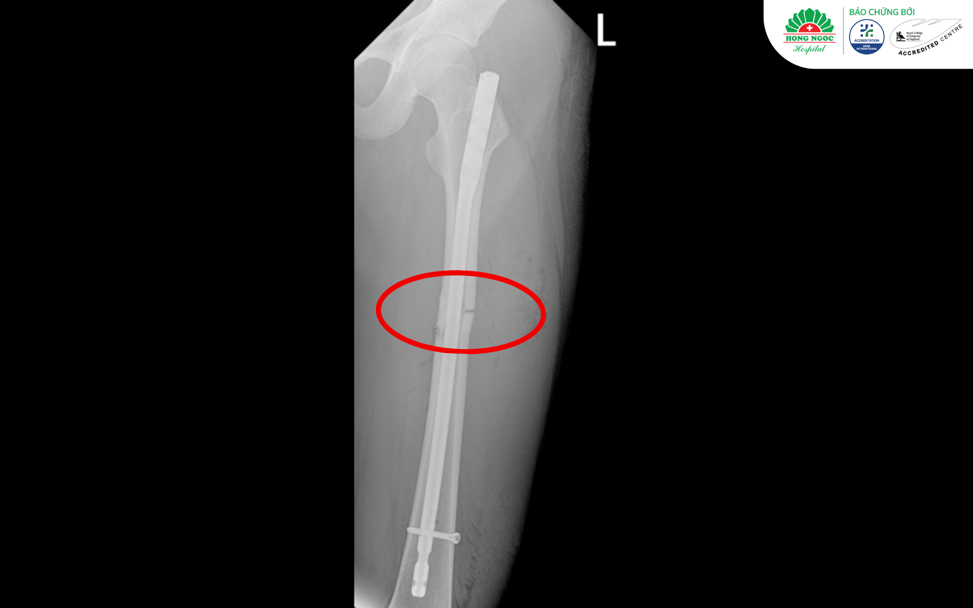 Anh 2 Thumb (2) 2