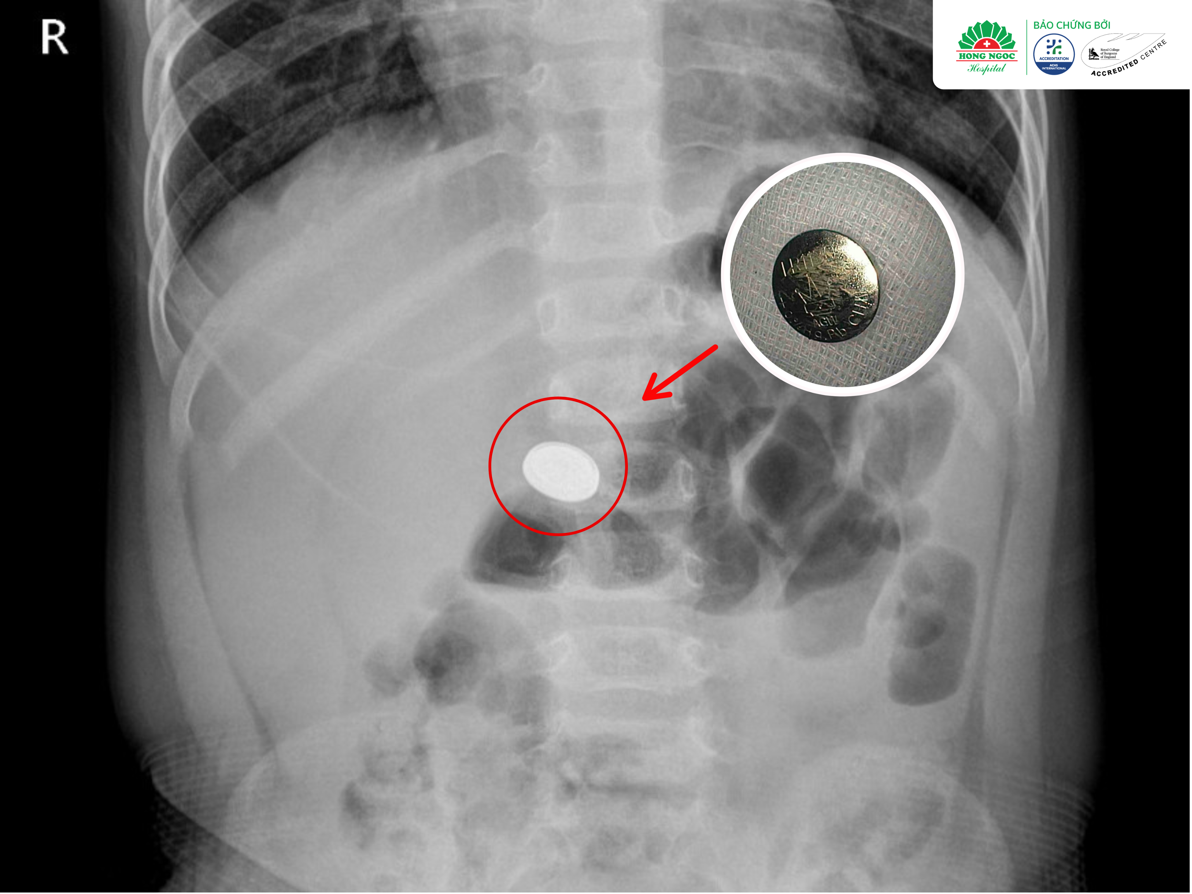 Cảnh Báo Trẻ Nuốt Dị Vật (2)