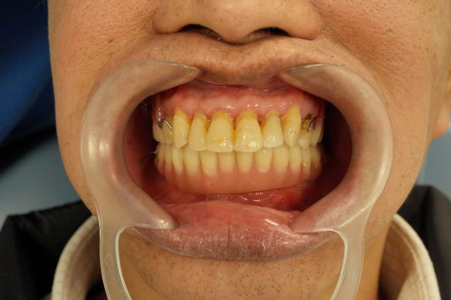 Implant phục hình toàn hàm All On 6