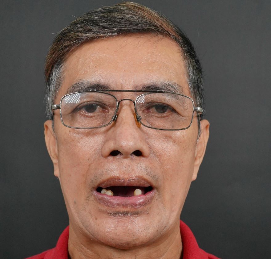 trồng răng implant