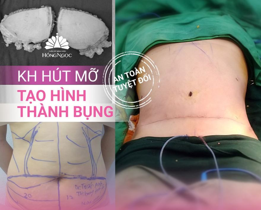 tạo hình thành bụng có chuyển rốn