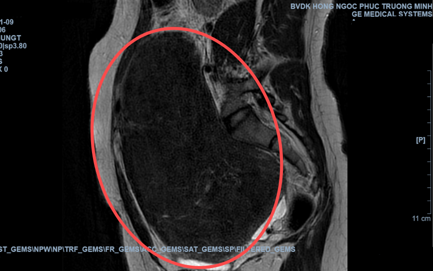 Khối U MRI