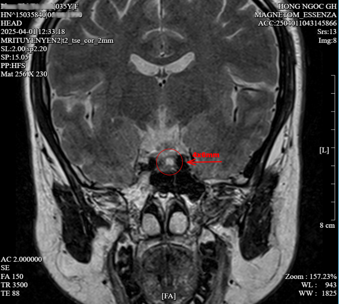 THS.BS ĐỖ HUY HOÀNG Thực Hiện LẤY MÁU TĨNH MẠCH XOANG ĐÁ DƯỚI (IPPS) Tại Phòng Can Thiệp Mạch Số Hóa Xóa Nền (DSA) (2)
