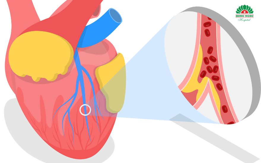 Myocardial infarction is a serious cardiovascular condition that can be life-threatening