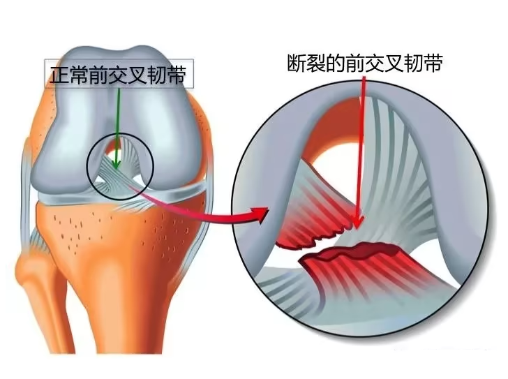 膝关节韧带