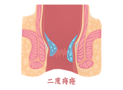 二度痔疮