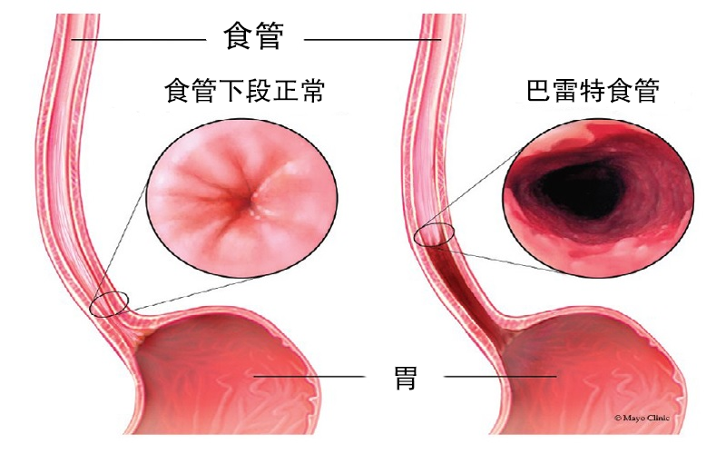 胃食管反流病的并发症涵盖巴雷特食管等癌前病变