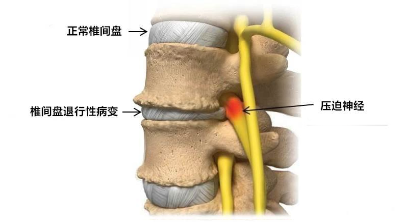 椎间盘退行性病变