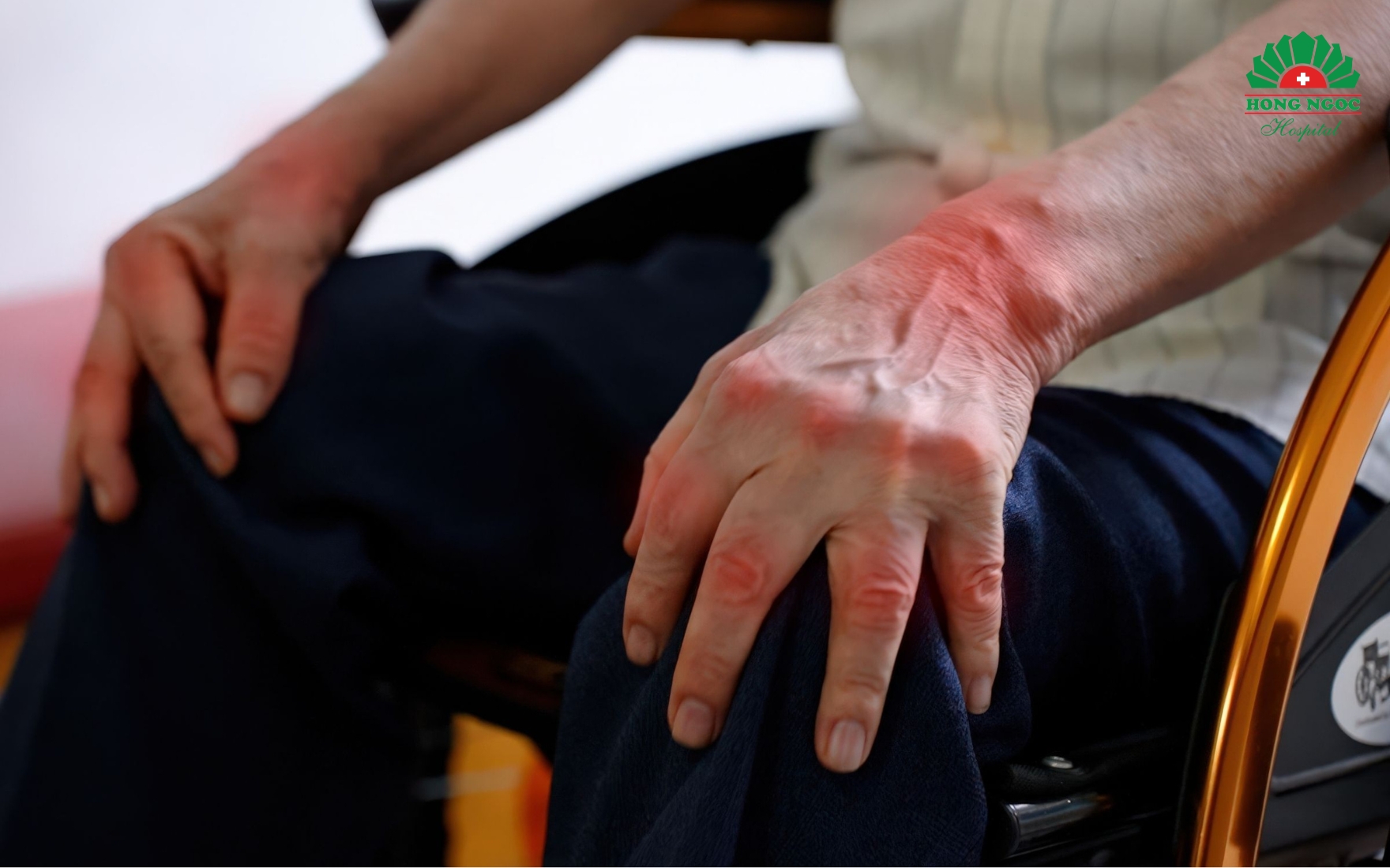 Tình trạng sưng đau xuất hiện ở nhiều khớp đối xứng