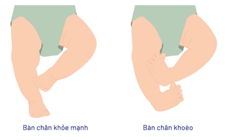 bàn chân khoèo bẩm sinh