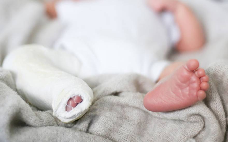 bàn chân khoèo bẩm sinh