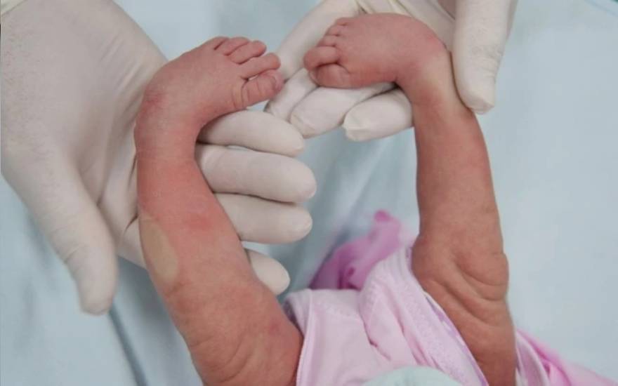 bàn chân khoèo bẩm sinh