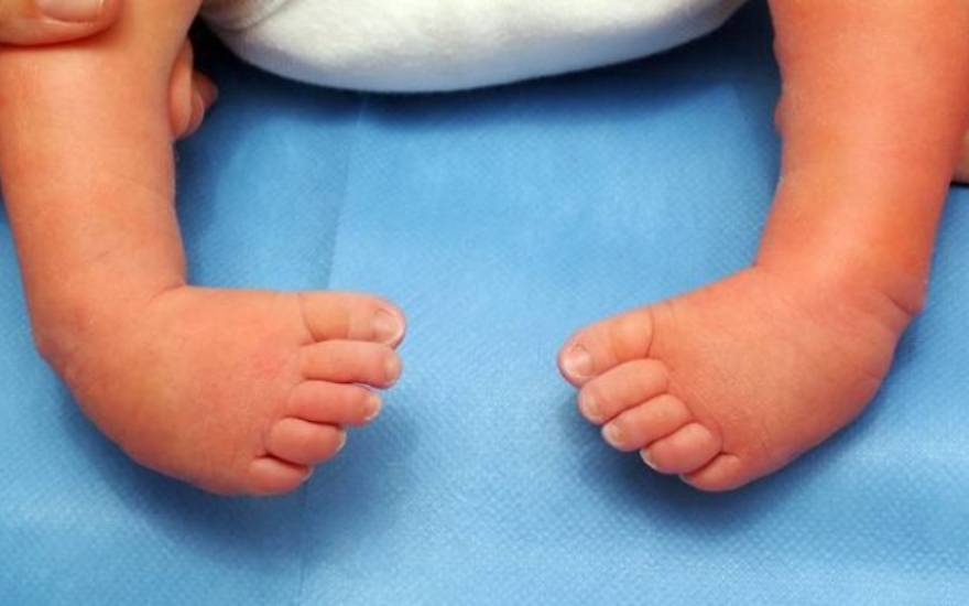 phẫu thuật dị tật bẩm sinh ở chân