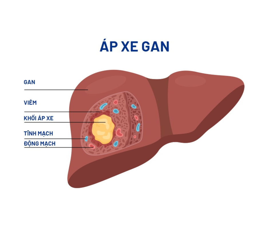 Phương pháp điều trị áp xe gan