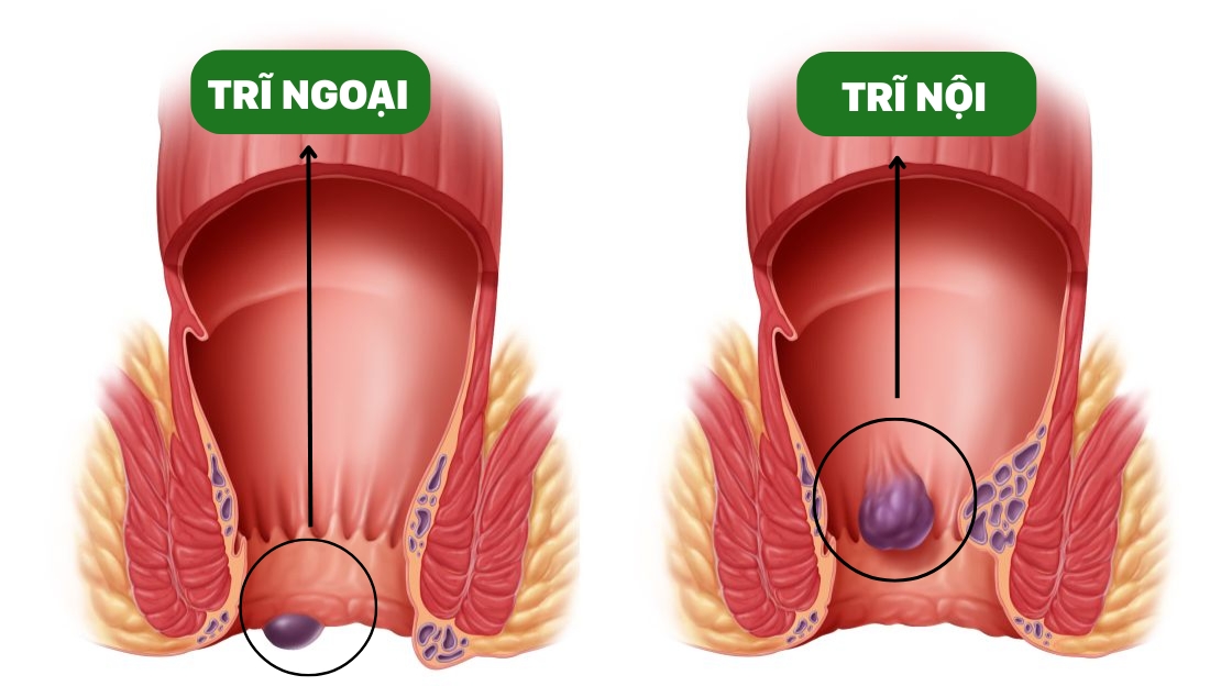 benh-tri-co-tu-khoi-khong