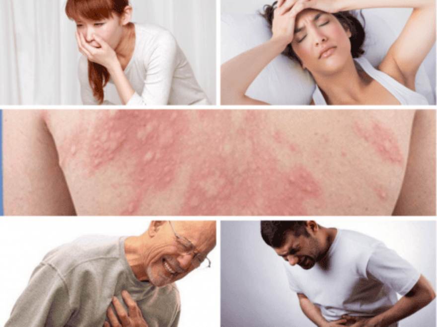 biến chứng của mày đay là sốc phản vệ