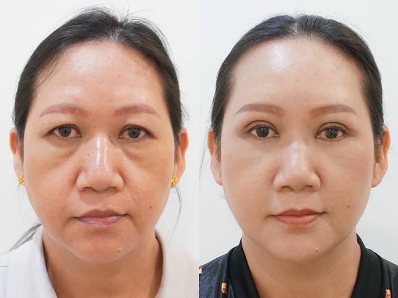 cắt mí do sụp mí mắt