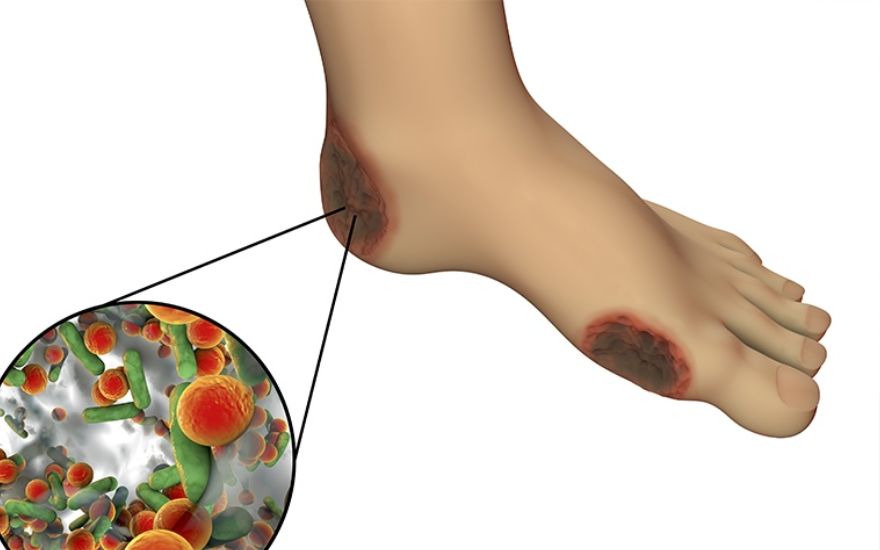 Cắt xương hoại tử