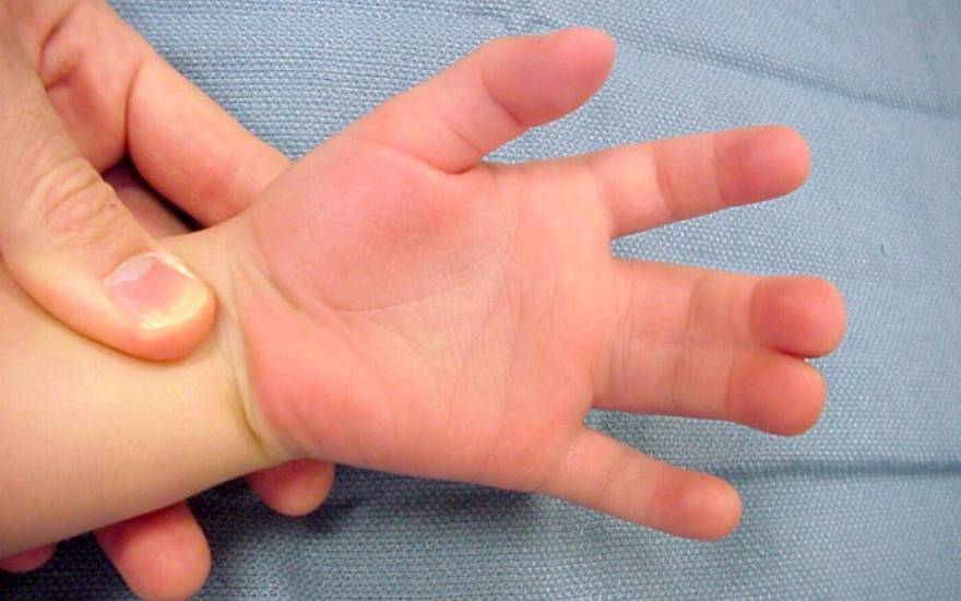 phẫu thuật dị tật bẩm sinh ở tay