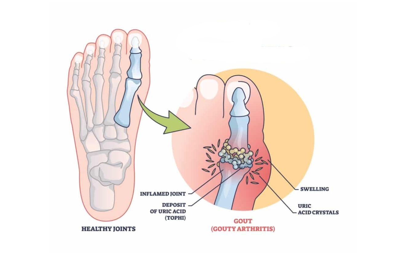 Bệnh gout gây khó chịu, đau nhức cho người bệnh  