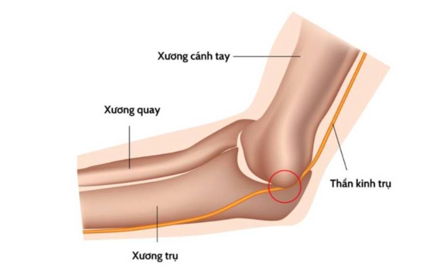 hội chứng đường hầm xương trụ