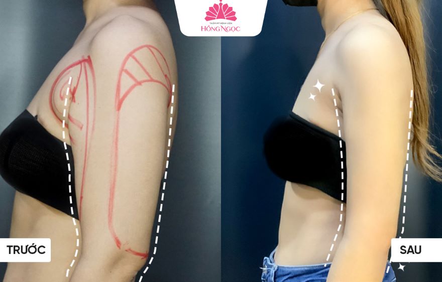 hút mỡ bắp tay