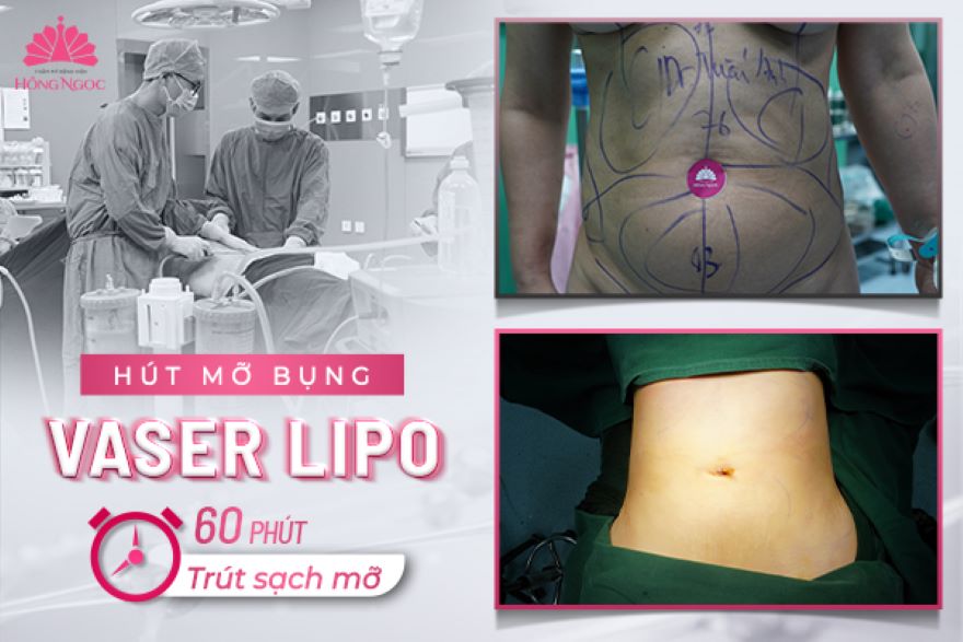 hút mỡ bụng tại Thẩm Mỹ Bệnh Viện Hồng Ngọc