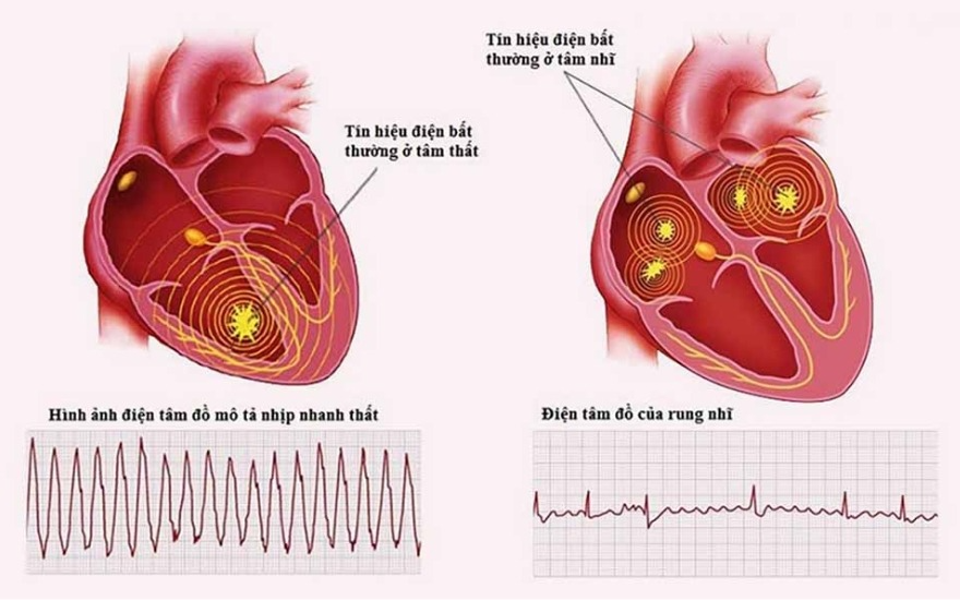 Rối loạn nhịp tim, rung nhĩ