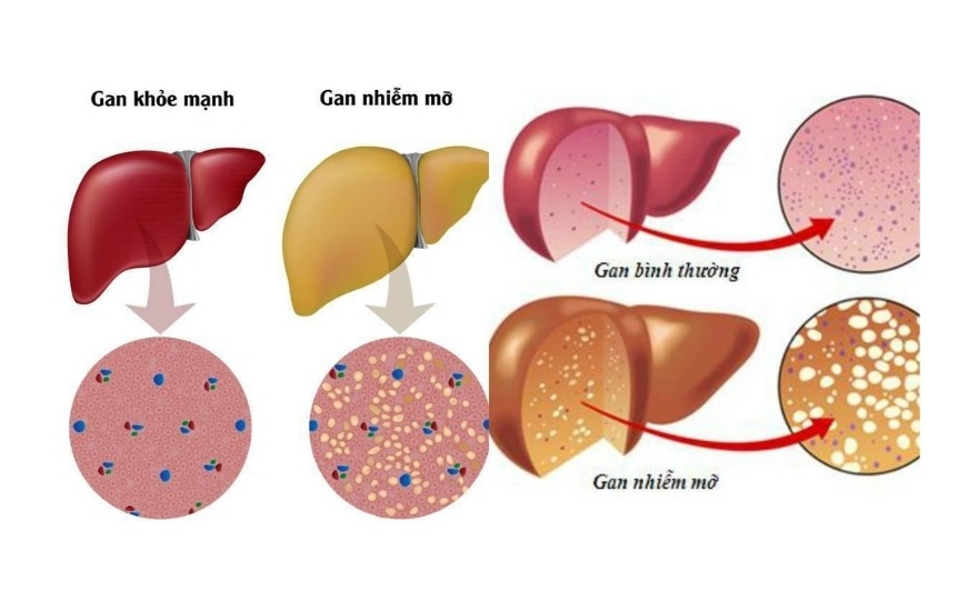 Kháng insulin làm gan tăng tổng hợp mỡ và rối loạn xử lý glucose