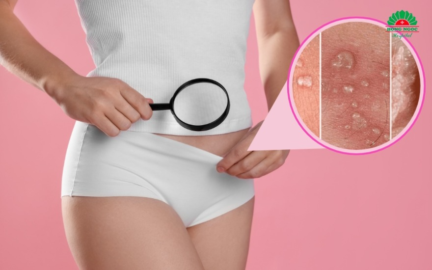 Trong các loại mụn mọc ở vùng kín, mụn nước gây lở loét, đau rát và cảnh báo bệnh mụn rộp sinh dục nguy hiểm do virus HSV gây ra 
