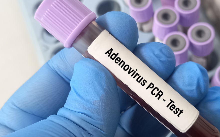 Key: phòng lây nhiễm Adenovirus cho trẻ URL: phong-lay-nhiem-adenovirus-cho-tre Meta: Hướng dẫn phòng lây nhiễm Adenovirus cho trẻ khi dịch gia tăng như rửa tay, vệ sinh đồ dùng, hạn chế nguồn lây và nhận biết sớm dấu hiệu cần đi khám kịp thời. Làm gì để phòng lây nhiễm Adenovirus cho trẻ khi đang có dịch? Phòng lây nhiễm Adenovirus cho trẻ cần được thực hiện đồng thời tại nhà, trường học và nơi công cộng khi số ca có xu hướng tăng trong mùa hè. Theo Báo Nhân Dân ngày 11/7/2026, từ đầu năm đã ghi nhận 2.777 trẻ dương tính, gấp 3 lần cùng kỳ năm 2025; riêng những ngày đầu tháng 7 có thêm 383 trường hợp tại cơ sở báo cáo. Bài viết dưới đây giúp phụ huynh hiểu đường lây, áp dụng đúng biện pháp phòng bệnh và nhận biết dấu hiệu cần đưa trẻ đi khám. Trả lời nhanh: Phụ huynh nên cho trẻ rửa tay bằng xà phòng ít nhất 20 giây, không dùng chung đồ cá nhân, tránh tiếp xúc với người bệnh và vệ sinh thường xuyên đồ chơi, bề mặt dùng chung. Trẻ có biểu hiện sốt, ho, đau mắt đỏ, nôn hoặc tiêu chảy cần nghỉ ở nhà, không đi bơi và được đưa đi khám nếu khó thở, li bì, bỏ bú hoặc tiểu ít. Chủ động phòng Adenovirus giúp bảo vệ trẻ trong mùa dịch Tham vấn chuyên môn: BSCKII - Phạm Thị Như Hoa - Trưởng Khoa Nhi Bệnh Nhiệt Đới, Bệnh viện Đa khoa Hồng Ngọc. Ngày cập nhật: 17/07/2026. Tóm tắt nhanh bài viết: Phụ huynh nên cho trẻ rửa tay bằng xà phòng ít nhất 20 giây, nhất là trước khi ăn, sau khi đi vệ sinh và sau khi ho, hắt hơi. Trẻ đang sốt, ho, đau mắt đỏ, nôn hoặc tiêu chảy cần nghỉ ở nhà và không đến bể bơi, khu vui chơi. Gia đình không nên dùng chung khăn mặt, cốc uống nước, thìa, đồ chơi ngậm miệng hoặc vật dụng vệ sinh mắt với trẻ đang mắc bệnh. Người chăm sóc cần vệ sinh đồ chơi, tay nắm cửa, mặt bàn và các bề mặt thường xuyên tiếp xúc bằng sản phẩm khử khuẩn phù hợp. Trẻ khó thở, li bì, co giật, bỏ bú, tiểu ít hoặc sốt cao kéo dài cần được đưa đi khám sớm. Vì sao Adenovirus dễ lây lan giữa trẻ em? Adenovirus có thể lây qua nhiều đường cùng lúc, gồm giọt bắn khi người bệnh ho hoặc hắt hơi, tiếp xúc gần, bàn tay và bề mặt nhiễm virus, phân của người bệnh và nguồn nước không được khử khuẩn đầy đủ. Trẻ có thể nhiễm bệnh khi chạm vào đồ chơi, tay nắm cửa hoặc vật dụng có virus rồi đưa tay lên mắt, mũi hoặc miệng. Virus cũng có thể phát tán trong quá trình thay tã hoặc chăm sóc trẻ bị tiêu chảy. Trường học, lớp mầm non, khu vui chơi và bể bơi công cộng là những môi trường có nguy cơ lây chéo cao vì trẻ thường sinh hoạt gần nhau, dùng chung đồ vật và chưa duy trì tốt thói quen vệ sinh cá nhân. Đặc biệt, Adenovirus có thể tồn tại trên một số bề mặt và lây qua nước bể bơi nếu hệ thống lọc, vệ sinh hoặc khử khuẩn không bảo đảm. Vì vậy, phụ huynh nên cho trẻ nghỉ học, tạm dừng đi bơi và hạn chế đến nơi đông người khi trẻ đang sốt, ho, đau mắt đỏ, nôn hoặc tiêu chảy. Đường lây Tình huống thường gặp Cách hạn chế Đường hô hấp Ho, hắt hơi, nói chuyện ở khoảng cách gần Che miệng, tăng thông khí, tránh tiếp xúc gần với người đang ốm Bàn tay và bề mặt Đồ chơi, tay nắm cửa, bàn ghế, điện thoại Rửa tay và vệ sinh bề mặt thường xuyên Đường phân – miệng Thay tã, đi vệ sinh, chăm sóc trẻ tiêu chảy Rửa tay sau thay tã, bỏ tã bẩn vào túi kín, khử khuẩn bề mặt thường xuyên Niêm mạc mắt Dùng chung khăn, chạm tay bẩn lên mắt Không dùng chung khăn và hạn chế dụi mắt Nguồn nước Bể bơi thiếu chlorine hoặc vệ sinh không bảo đảm Chọn bể bơi được quản lý tốt, không cho trẻ đang ốm đi bơi Adenovirus dễ lây qua giọt bắn, bề mặt và nguồn nước Các biện pháp phòng lây nhiễm Adenovirus cho trẻ Phụ huynh có thể áp dụng các biện pháp dưới đây để giảm nguy cơ trẻ lây nhiễm Adenovirus. Hướng dẫn trẻ rửa tay đúng cách và đúng thời điểm Rửa tay bằng xà phòng là một trong những biện pháp quan trọng nhất để ngăn virus từ đồ vật, dịch tiết hoặc phân đi vào mắt, mũi và miệng. Trẻ nên làm ướt tay, tạo bọt, chà lòng bàn tay, mu bàn tay, kẽ ngón và vùng dưới móng trong ít nhất 20 giây, sau đó rửa sạch và lau khô. Phụ huynh cần nhắc trẻ rửa tay: Trước khi ăn hoặc chạm vào thức ăn. Sau khi đi vệ sinh hoặc thay tã. Sau khi ho, hắt hơi hoặc xì mũi. Sau khi đi học, đi bơi hoặc chơi ngoài trời. Sau khi chạm vào người đang ốm, khăn giấy hoặc dịch tiết. Khi không có xà phòng và nước sạch, người chăm sóc có thể dùng dung dịch sát khuẩn tay chứa ít nhất 60% cồn. Trẻ nhỏ cần được người lớn giám sát để tránh nuốt dung dịch hoặc đưa dung dịch vào mắt. Rửa tay đúng cách giúp loại bỏ virus trên da Giữ vệ sinh hô hấp, đeo khẩu trang và làm phòng thông thoáng Phụ huynh nên hướng dẫn trẻ ho hoặc hắt hơi vào khăn giấy hay khuỷu tay áo, sau đó bỏ khăn giấy vào thùng rác và rửa tay. Trẻ không nên dùng bàn tay che miệng vì virus có thể tiếp tục phát tán sang đồ vật và người xung quanh. Trẻ từ 2 tuổi trở lên có thể đeo khẩu trang khi đến cơ sở y tế, đi phương tiện công cộng hoặc ở nơi đông người, thông khí kém. Gia đình cũng nên mở cửa sổ khi điều kiện cho phép và hạn chế để trẻ ở lâu trong phòng kín. Khẩu trang cần che kín mũi, miệng và được thay khi ẩm hoặc bẩn. Đeo khẩu trang giúp hạn chế giọt bắn Hạn chế trẻ tiếp xúc với nguồn lây Trẻ đang sốt, ho nhiều, đau mắt đỏ, nôn hoặc tiêu chảy nên nghỉ học, không đi bơi và tránh đến khu vui chơi hoặc nơi đông người. Việc cho trẻ nghỉ tại nhà vừa hỗ trợ quá trình hồi phục vừa giảm nguy cơ lây bệnh cho cộng đồng. Nếu trong gia đình có người đang mắc bệnh, phụ huynh nên hạn chế ôm hôn, tiếp xúc mặt đối mặt và dùng chung vật dụng với trẻ. Người chăm sóc cần rửa tay sau khi lau mũi, vệ sinh mắt, thay tã hoặc xử lý chất nôn, đồng thời không để trẻ khỏe chơi với đồ chơi chưa được làm sạch. Trẻ nên tránh tiếp xúc gần với người đang mắc bệnh Giữ vệ sinh cơ thể, đồ dùng và không gian sống Phụ huynh nên tắm rửa, thay quần áo cho trẻ sau khi trở về từ trường học, khu vui chơi hoặc nơi đông người. Tay nắm cửa, công tắc, mặt bàn, điện thoại, nhà vệ sinh và đồ chơi dùng chung cũng cần được vệ sinh thường xuyên bằng sản phẩm phù hợp, đúng hướng dẫn trên nhãn. Trẻ không nên dùng chung khăn mặt, khăn tắm, gối, cốc uống nước, thìa, thuốc nhỏ mắt hoặc vật dụng vệ sinh cá nhân. Đồ chơi trẻ thường đưa vào miệng cần được làm sạch sau khi sử dụng và không chuyển ngay cho trẻ khác. Đồ dùng của trẻ cần được vệ sinh thường xuyên Chăm sóc an toàn khi trẻ đau mắt đỏ hoặc tiêu chảy Adenovirus có thể gây viêm kết mạc, nôn và tiêu chảy. Khi trẻ đỏ mắt hoặc chảy nhiều dịch mắt, người chăm sóc không nên dùng chung khăn lau giữa hai mắt hoặc giữa các thành viên trong gia đình. Khăn vải cần được giặt sạch và làm khô; bông hoặc khăn giấy dùng một lần phải được bỏ ngay sau khi sử dụng. Khi thay tã hoặc vệ sinh cho trẻ tiêu chảy, người chăm sóc cần xử lý tã đúng cách và rửa tay ngay sau đó. Gia đình nên duy trì vệ sinh tay và đồ dùng sau khi triệu chứng cải thiện vì virus có thể tiếp tục được đào thải trong một khoảng thời gian. Vệ sinh đúng cách giúp hạn chế virus phát tán Thận trọng khi cho trẻ đi bơi Adenovirus có thể lây qua nguồn nước nếu bể bơi không được lọc và khử khuẩn đúng cách. Phụ huynh nên lựa chọn bể bơi có quy trình vệ sinh rõ ràng, đồng thời không cho trẻ đi bơi khi đang sốt, ho nhiều, đau mắt đỏ, nôn hoặc tiêu chảy. Trong thời điểm số ca bệnh gia tăng, gia đình có thể giảm các buổi bơi tại bể công cộng đông người. Trẻ sơ sinh, trẻ có bệnh tim phổi mạn tính hoặc suy giảm miễn dịch cần được bảo vệ thận trọng hơn. Không cho trẻ đang mắc bệnh đến bể bơi Duy trì bú mẹ và chế độ ăn đầy đủ dưỡng chất Trẻ nên được bú mẹ hoàn toàn trong 6 tháng đầu nếu điều kiện sức khỏe của mẹ và bé cho phép, sau đó ăn bổ sung phù hợp và tiếp tục bú mẹ đến 2 tuổi hoặc lâu hơn. Sữa mẹ cung cấp dinh dưỡng và kháng thể, góp phần hỗ trợ trẻ chống lại nhiều bệnh nhiễm trùng thường gặp. Từ 6 tháng tuổi, trẻ cần được ăn đa dạng các nhóm thực phẩm như thịt, cá, trứng, sữa, đậu, rau xanh và trái cây. Phụ huynh nên cho trẻ uống đủ nước, ăn chín uống sôi và không tự ý sử dụng vitamin hoặc sản phẩm quảng cáo “tăng đề kháng”. Bú mẹ và dinh dưỡng đầy đủ giúp duy trì thể trạng nhưng không phòng đặc hiệu Adenovirus. Dinh dưỡng đầy đủ giúp trẻ duy trì thể trạng khỏe mạnh Phối hợp với trường học và cơ sở trông trẻ Trường học và lớp mầm non cần duy trì khu vực rửa tay, vệ sinh đồ chơi, làm thông thoáng lớp học và theo dõi trẻ có dấu hiệu bất thường. Khi trẻ xuất hiện sốt, đau mắt đỏ, nôn hoặc tiêu chảy, nhà trường nên thông báo cho gia đình và hạn chế để trẻ tiếp xúc gần với các bạn trong thời gian chờ đón. Phụ huynh nên thông báo cho nhà trường khi trẻ được chẩn đoán mắc Adenovirus. Thông tin kịp thời giúp cơ sở giáo dục tăng cường vệ sinh, theo dõi các trường hợp liên quan và chủ động thực hiện biện pháp hạn chế lây nhiễm. Gia đình và nhà trường cần phối hợp phòng lây nhiễm Nếu trong nhà đã có trẻ mắc Adenovirus, cha mẹ nên làm gì? Gia đình nên áp dụng đồng thời nhiều biện pháp thay vì chỉ tập trung vào một việc như nhỏ nước muối sinh lý hoặc xịt khử khuẩn. Nước muối có thể hỗ trợ làm sạch dịch mũi theo hướng dẫn phù hợp nhưng không thay thế việc rửa tay, hạn chế tiếp xúc và vệ sinh bề mặt. Phụ huynh có thể thực hiện theo thứ tự sau: Cho trẻ nghỉ tại nhà: Trẻ không nên đi học, đi bơi hoặc đến nơi đông người khi còn biểu hiện bệnh. Giảm tiếp xúc gần: Gia đình nên hạn chế để trẻ dùng chung giường, khăn, cốc và đồ chơi với anh chị em. Kiểm soát dịch tiết: Người chăm sóc cần rửa tay sau khi lau mũi, mắt, dọn chất nôn hoặc thay tã. Vệ sinh vật dụng chung: Tay nắm cửa, bàn ăn, bồn rửa và nhà vệ sinh cần được vệ sinh thường xuyên. Theo dõi toàn trạng: Phụ huynh cần quan sát nhịp thở, mức độ tỉnh táo, khả năng ăn bú, lượng nước tiểu, nôn và tiêu chảy. Adenovirus là virus nên kháng sinh không có tác dụng trực tiếp. Phụ huynh không nên tự cho trẻ dùng kháng sinh, tự phối hợp thuốc hạ sốt hoặc dùng thuốc nhỏ mắt có kháng sinh, corticoid khi chưa được bác sĩ thăm khám. Hiện cũng chưa có thuốc kháng virus đặc hiệu được phê duyệt cho đa số trường hợp nhiễm Adenovirus thông thường. Gia đình cần chủ động hạn chế lây nhiễm chéo Khi nào trẻ cần được đưa đi khám? Phụ huynh cần đưa trẻ đi khám sớm nếu trẻ sốt cao kéo dài, ho tăng dần, đau mắt đỏ nhiều, nôn, tiêu chảy hoặc ăn uống kém. Trẻ có bệnh tim, bệnh phổi, suy giảm miễn dịch hoặc còn quá nhỏ cần được đánh giá sớm hơn vì nguy cơ diễn biến nặng cao hơn. Trẻ cần được đưa đến cơ sở y tế hoặc cấp cứu ngay khi có một trong các dấu hiệu: Khó thở, thở gắng sức, rút lõm lồng ngực hoặc tím môi. Li bì, khó đánh thức, phản ứng chậm hoặc co giật. Không uống được, bỏ bú hoặc nôn liên tục. Tiểu ít, tã khô lâu, môi khô, mắt trũng hoặc khóc không có nước mắt. Trẻ dưới 3 tháng tuổi sốt từ 38°C trở lên. Đau mắt dữ dội, sợ ánh sáng hoặc thị lực thay đổi. Sốt cao khó hạ hoặc kéo dài trên nhiều ngày. Phụ huynh có thể tham khảo thêm bài viết trẻ sốt mùa hè khi nào nguy hiểm để nhận biết các biểu hiện khó thở, mất nước, co giật và thay đổi ý thức cần được bác sĩ đánh giá. Những dấu hiệu này không đủ để tự chẩn đoán Adenovirus vì nhiều bệnh nhiễm trùng ở trẻ có thể biểu hiện tương tự. Đưa trẻ đi khám khi xuất hiện dấu hiệu bất thường Câu hỏi thường gặp về phòng lây nhiễm Adenovirus cho trẻ Adenovirus đã có vắc xin phòng bệnh cho trẻ chưa? Hiện chưa có thuốc điều trị đặc hiệu cho Adenovirus. Phác đồ điều trị chủ yếu tập trung vào việc giảm triệu chứng và tăng sức đề kháng. Vắc xin phòng Adenovirus type 4 và 7 chỉ được sử dụng trong một số nhóm quân nhân Hoa Kỳ, không được phê duyệt cho cộng đồng. Vì vậy, vệ sinh tay, hạn chế tiếp xúc nguồn bệnh và kiểm soát môi trường vẫn là biện pháp phòng ngừa chính. Trẻ từng mắc Adenovirus có thể mắc lại không? Trẻ có thể mắc lại vì Adenovirus gồm nhiều type khác nhau và lần nhiễm trước không đồng nghĩa trẻ được bảo vệ trước tất cả các type. Gia đình vẫn cần duy trì các biện pháp vệ sinh và phòng lây sau khi trẻ đã khỏi bệnh. Trẻ không có triệu chứng có cần xét nghiệm Adenovirus không? Trẻ khỏe mạnh, không có triệu chứng thường không cần tự làm xét nghiệm chỉ vì đang có nhiều ca bệnh. Bác sĩ sẽ cân nhắc xét nghiệm dựa trên triệu chứng, mức độ bệnh, tiền sử tiếp xúc và nguy cơ biến chứng. Phụ huynh không nên xem kết quả xét nghiệm là yếu tố duy nhất để quyết định chăm sóc hoặc điều trị. Người lớn có thể lây Adenovirus cho trẻ không? Có. Adenovirus có thể gây bệnh ở mọi lứa tuổi và lây qua tiếp xúc gần, ho, hắt hơi, bàn tay, bề mặt, phân hoặc nguồn nước nhiễm virus. Người lớn đang có triệu chứng nên hạn chế tiếp xúc gần, không dùng chung vật dụng và rửa tay trước khi chăm sóc trẻ. Kết luận Phòng lây nhiễm Adenovirus cho trẻ cần dựa trên nhiều lớp bảo vệ, gồm rửa tay đúng cách, che miệng khi ho, giữ không gian thông thoáng, không dùng chung đồ cá nhân, vệ sinh bề mặt và cho trẻ đang ốm nghỉ tại nhà. Phụ huynh không nên quá hoang mang nhưng cũng không nên chỉ dựa vào thuốc bổ, nước muối sinh lý hoặc tự dùng kháng sinh để phòng bệnh. Nếu trẻ sốt cao kéo dài, ho tăng, đau mắt đỏ, nôn, tiêu chảy hoặc có dấu hiệu khó thở, mất nước và giảm tỉnh táo, gia đình nên đưa trẻ đến cơ sở y tế. Khoa Nhi Bệnh nhiệt đới - Bệnh viện Đa Khoa Hồng Ngọc tiếp nhận thăm khám các bệnh lý hô hấp ở trẻ và triển khai sàng lọc, phân luồng bệnh nhi nghiêm ngặt nhằm hạn chế lây nhiễm chéo; đảm bảo an toàn trong suốt quá trình thăm khám và điều trị. Lưu ý y khoa: Bài viết chỉ có giá trị tham khảo, không thay thế việc thăm khám, chẩn đoán hoặc điều trị của bác sĩ. Phụ huynh nên đưa trẻ đi khám sớm nếu trẻ sốt cao kéo dài, khó thở, li bì, bỏ bú, nôn nhiều, tiểu ít hoặc đau mắt kèm thay đổi thị lực. Tài liệu tham khảo: CDC. About Adenovirus, cập nhật ngày 16/12/2025. CDC. Guidelines for Adenovirus Outbreaks, cập nhật ngày 17/12/2025. CDC. About Handwashing, hướng dẫn rửa tay tối thiểu 20 giây. WHO. Infection Prevention and Control, hướng dẫn chung về vệ sinh tay, vệ sinh hô hấp và kiểm soát lây nhiễm. American Academy of Pediatrics. Adenovirus Infections in Infants and Children. CDC. When Students or Staff Are Sick, hướng dẫn nghỉ học và quay lại trường.