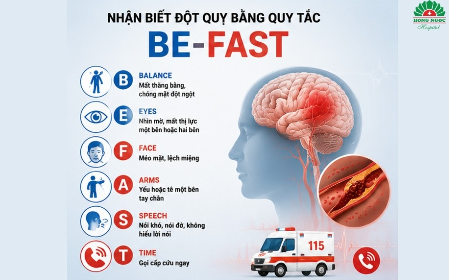 Nguyên tắc BE-FAST nhận biết đột quỵ