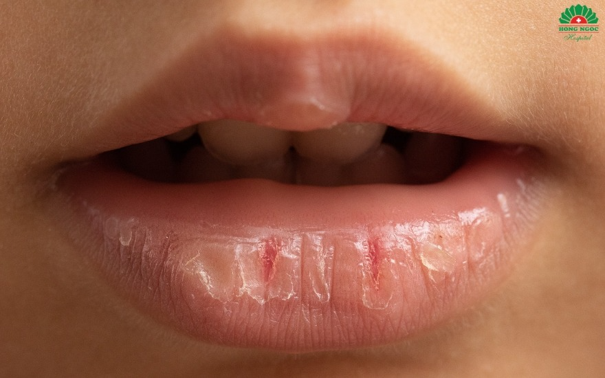 Mất nước âm thầm mùa hè: Dấu hiệu sớm không nên bỏ qua