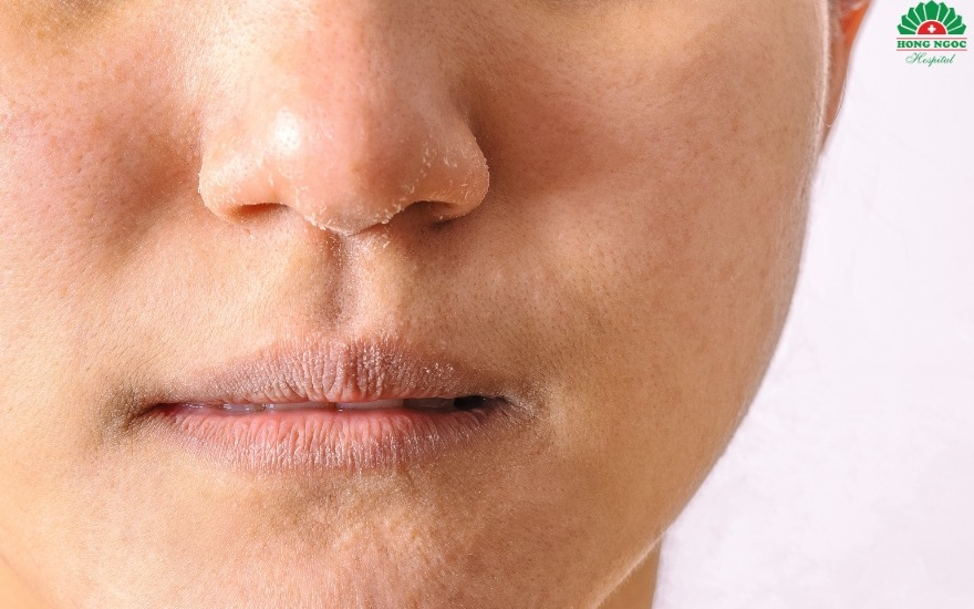 Mất nước âm thầm mùa hè: Dấu hiệu sớm không nên bỏ qua