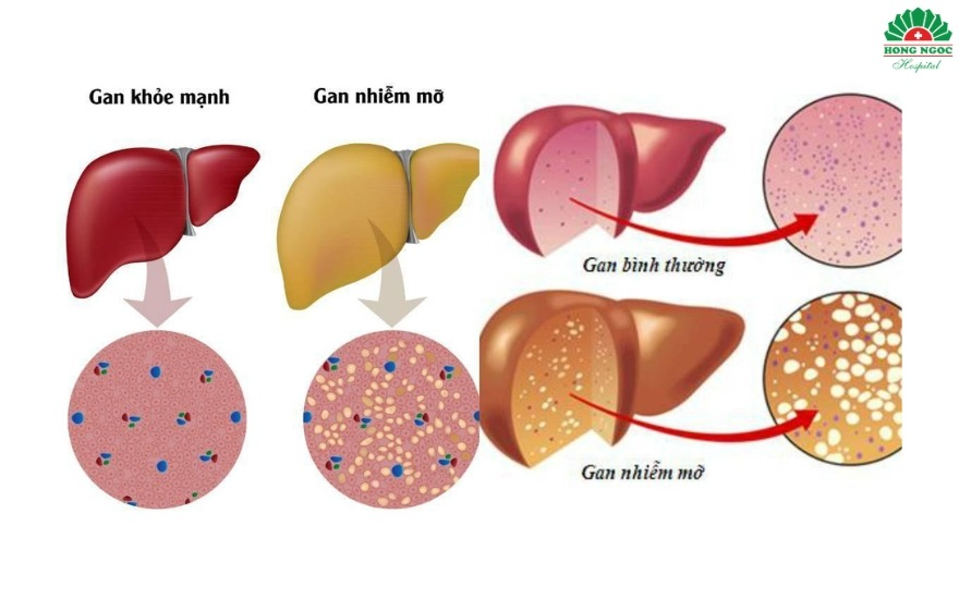 Người có BMI cao dễ tích tụ mỡ trong gan