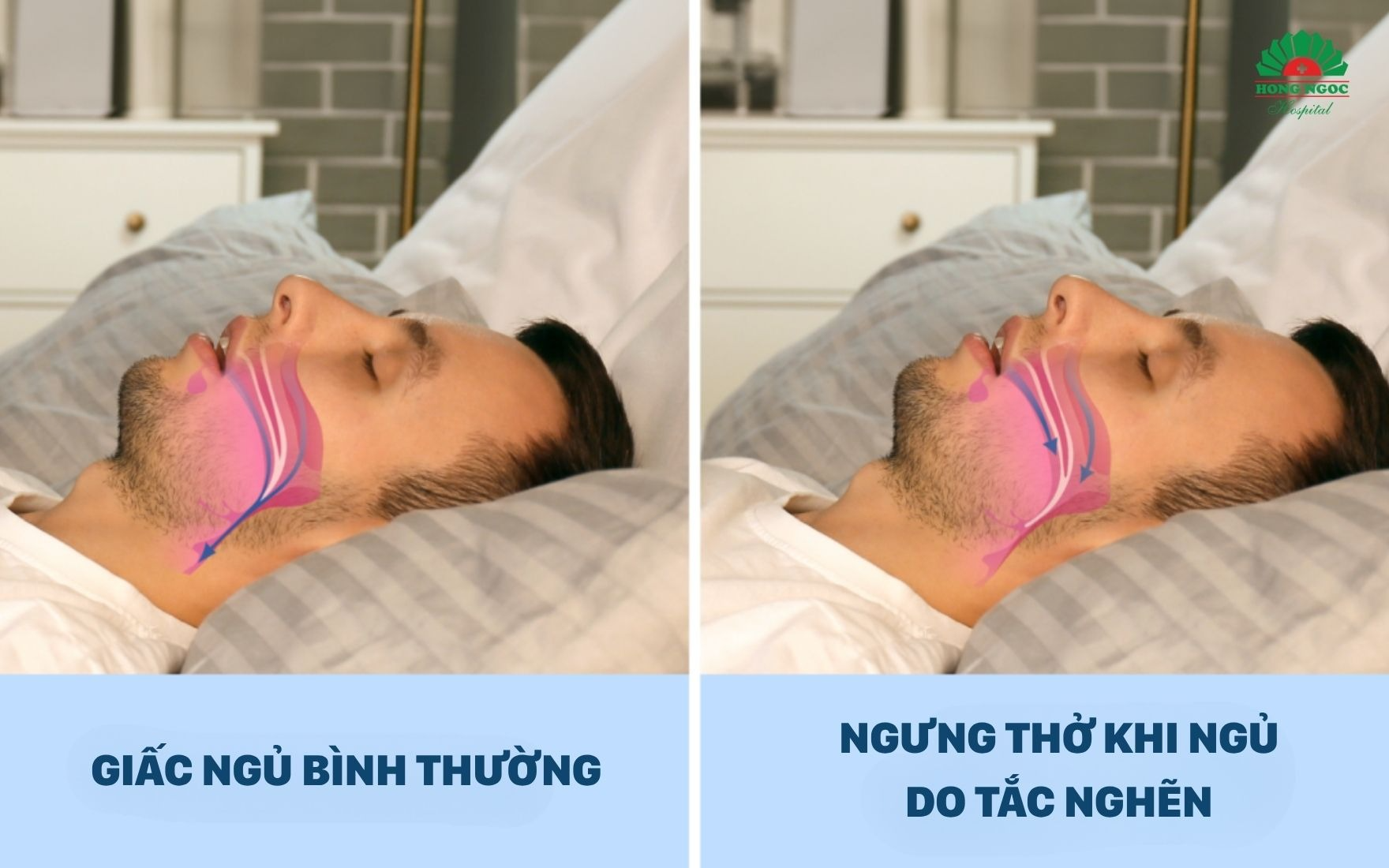 Người thừa cân, béo phì có nguy cơ cao hơn mắc ngưng thở khi ngủ do tắc nghẽn