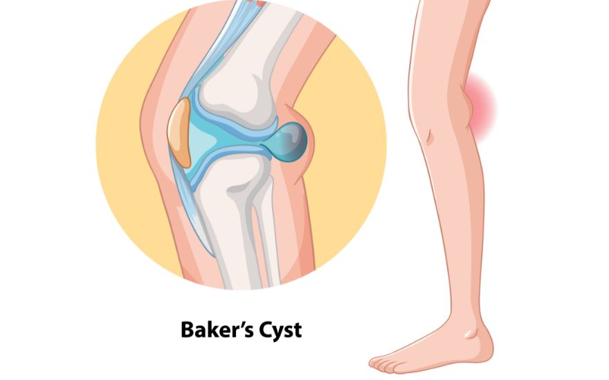 Kén hoạt dịch Baker