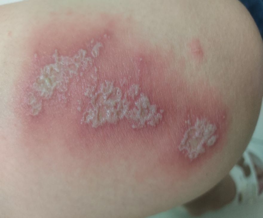 viêm da tiếp xúc do bị kiến ba khoang đốt