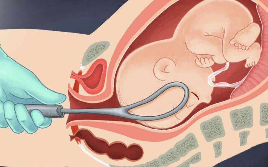 liệt đám rối thần kinh cánh tay