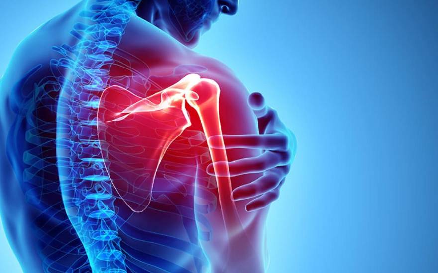 liệt đám rối thần kinh cánh tay