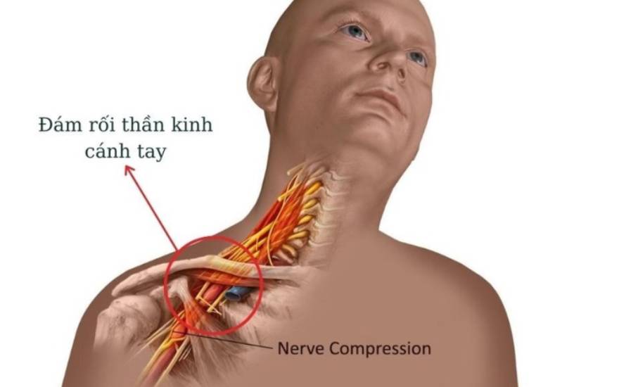 liệt đám rối thần kinh cánh tay