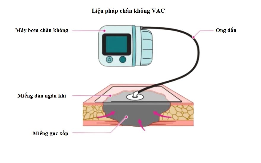 Điều trị nhiễm khuẩn bằng liệu pháp chân không VAC