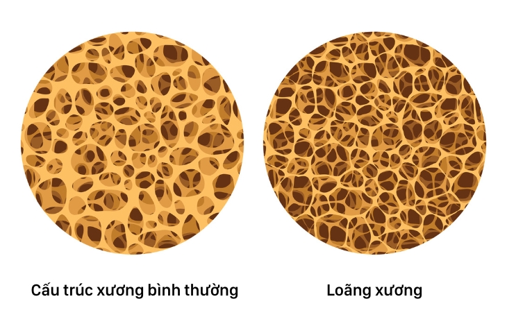 loãng xương nặng có xẹp đốt sống