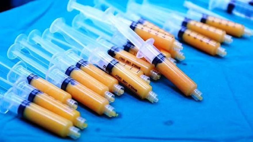 nâng ngực bằng mỡ tự thân