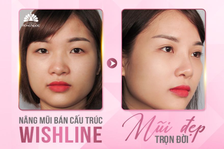 nâng mũi Hồng Ngọc