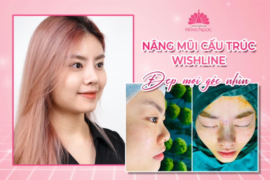 phẫu thuật nâng mũi