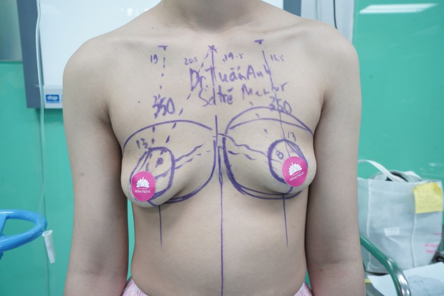 nâng ngực chảy xệ