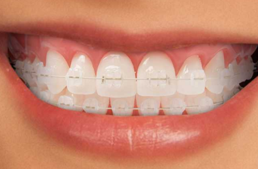 niềng răng mắc cài sứ